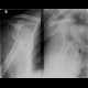 Comminuted fracture of the head of humerus: X-ray - Plain radiograph